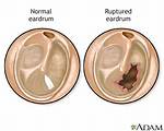 Does Ruptured Eardrums Hurt?