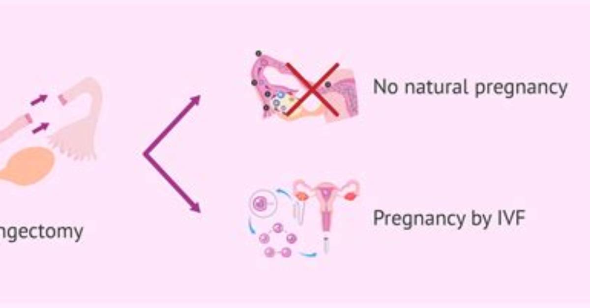 Does Salpingectomy Affect Hormones?