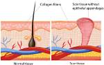 Does Scar Tissue Grow?