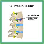 Does Schmorl's Node Cause Pain?