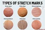 Does Scratching Worsen Stretch Marks?