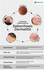 Does Seborrheic Dermatitis Spread?