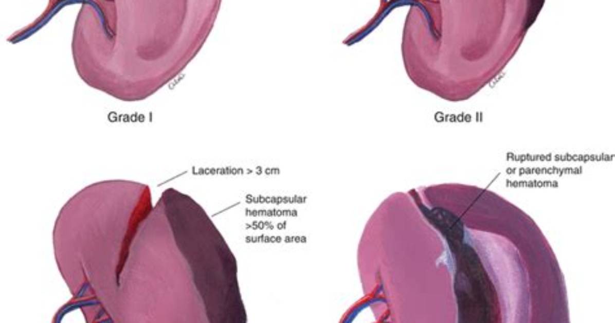 Does Shattered Spleen Stack?