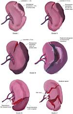Does Shattered Spleen Stack?
