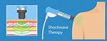 Does Shockwave Therapy Work?