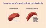 Does Sickle Cell Prevent Malaria?