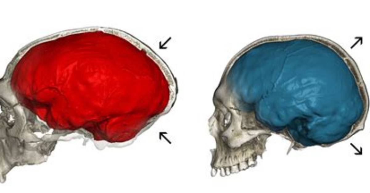 Does Skull Shape Affect Brain?