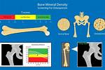 Does Solis Do Bone Density Test?