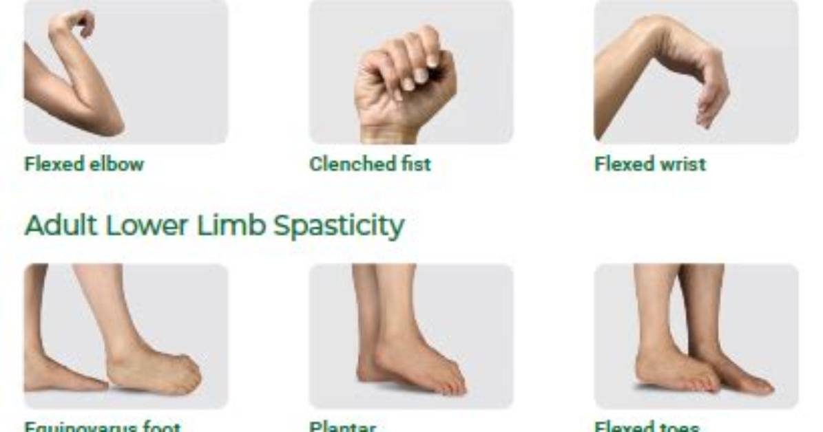 Does Spasticity Cause Contractures?