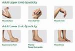 Does Spasticity Cause Contractures?