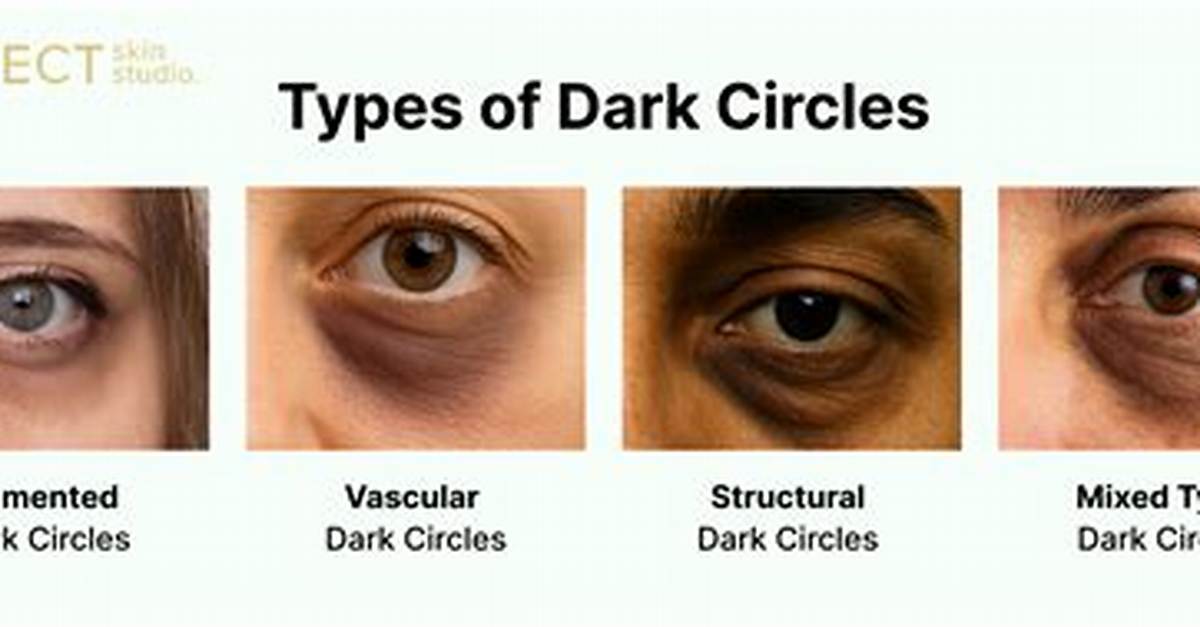 Does Specs Cause Dark Circles?