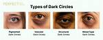 Does Specs Cause Dark Circles?