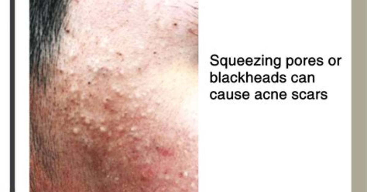 Does Squeezing Spots Cause Scars?