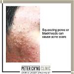 Does Squeezing Spots Cause Scars?