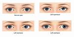 Does Squint Eye Go Away?