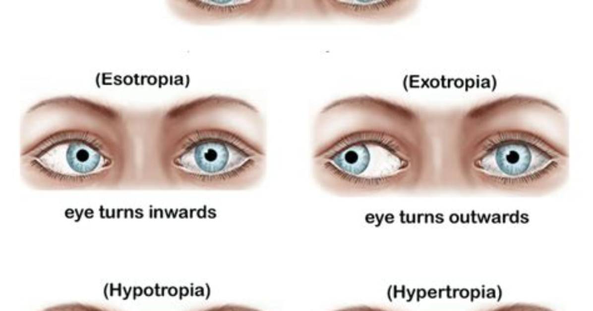 Does Squinting Eyes Affect Vision?