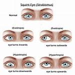 Does Squinting Eyes Affect Vision?