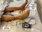 Does Stim Help Swelling