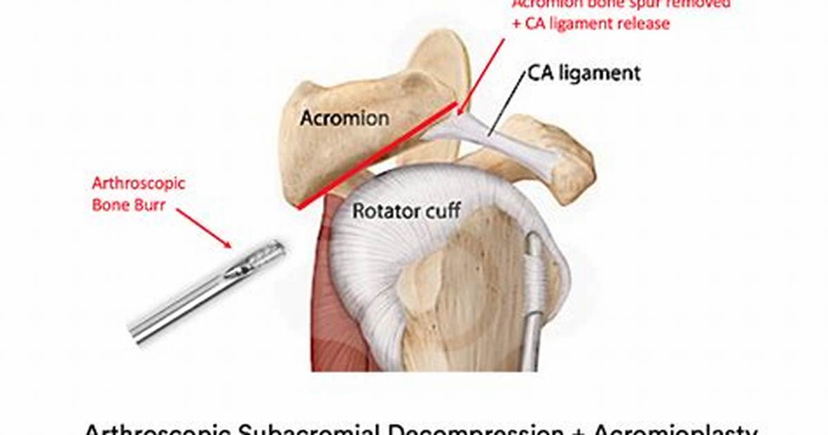 Does Subacromial Decompression Work?