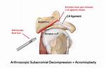 Does Subacromial Decompression Work?