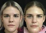 Does Subcision Work for Ice Pick Scars?
