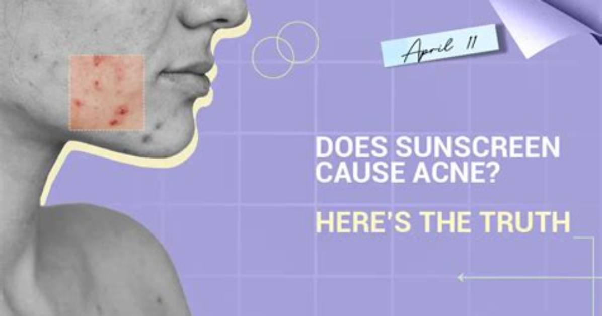 Does Sunscreen Cause Acne?