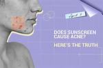 Does Sunscreen Cause Acne?