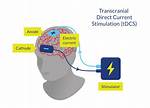Does Tdcs Really Work?