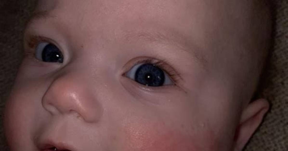 Does Teething Cause Red Cheeks?