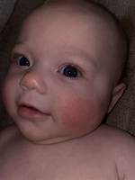 Does Teething Cause Red Cheeks?