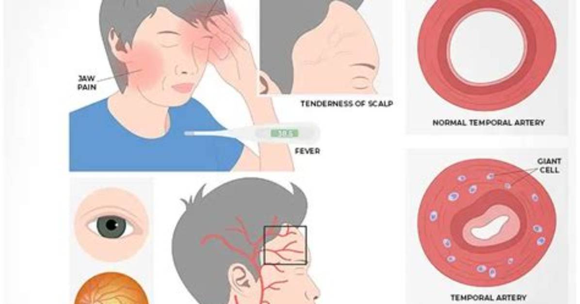Does Temporal Arteritis Go Away?