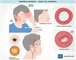 Does Temporal Arteritis Go Away?