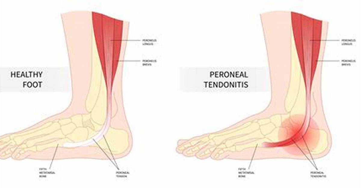 Does Tendonitis Go Away?
