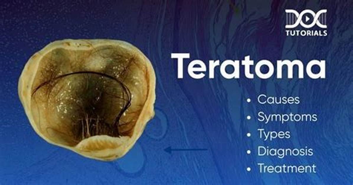 Does Teratomas Come Back?