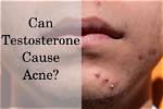 Does Testosterone Cause Acne?