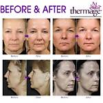 Does Thermage Work on Face