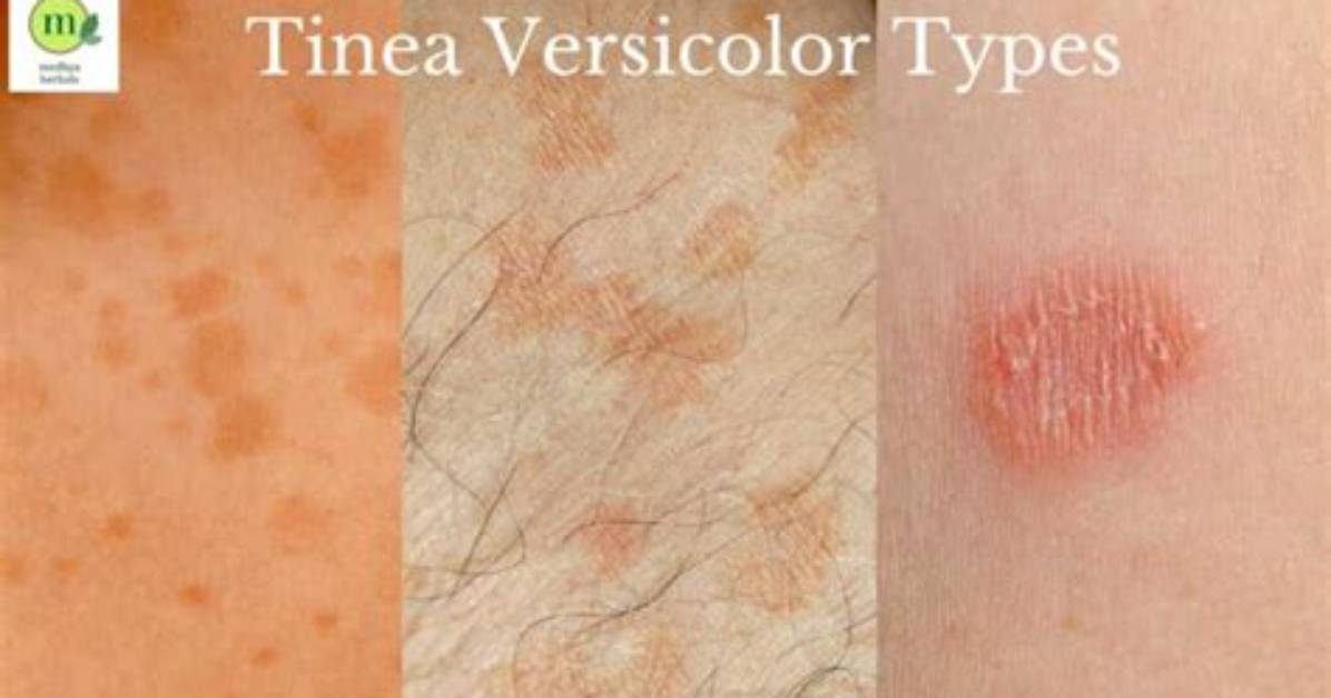 Does Tinea Versicolor Spread?