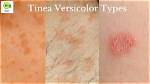 Does Tinea Versicolor Spread?