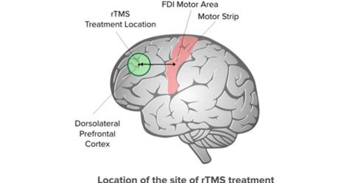 Does Tms Cause Brain Damage?