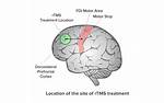 Does Tms Cause Brain Damage?