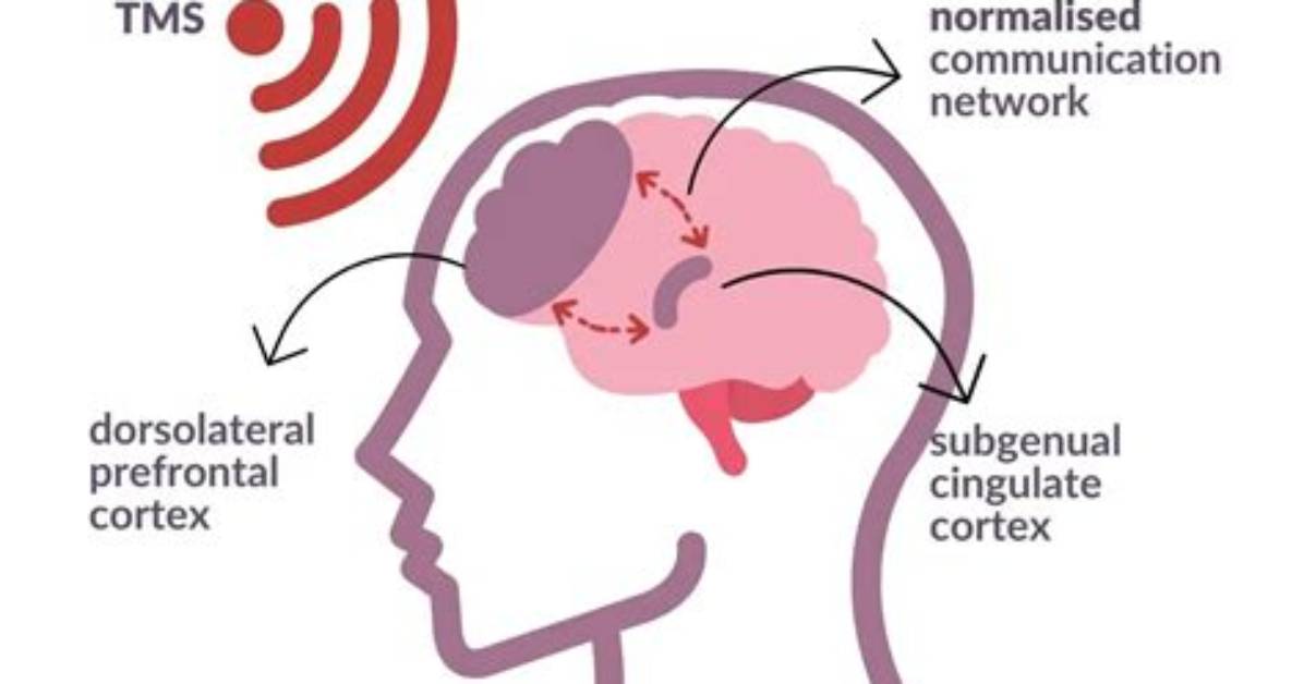 Does Tms Show Causation?
