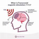 Does Tms Show Causation?