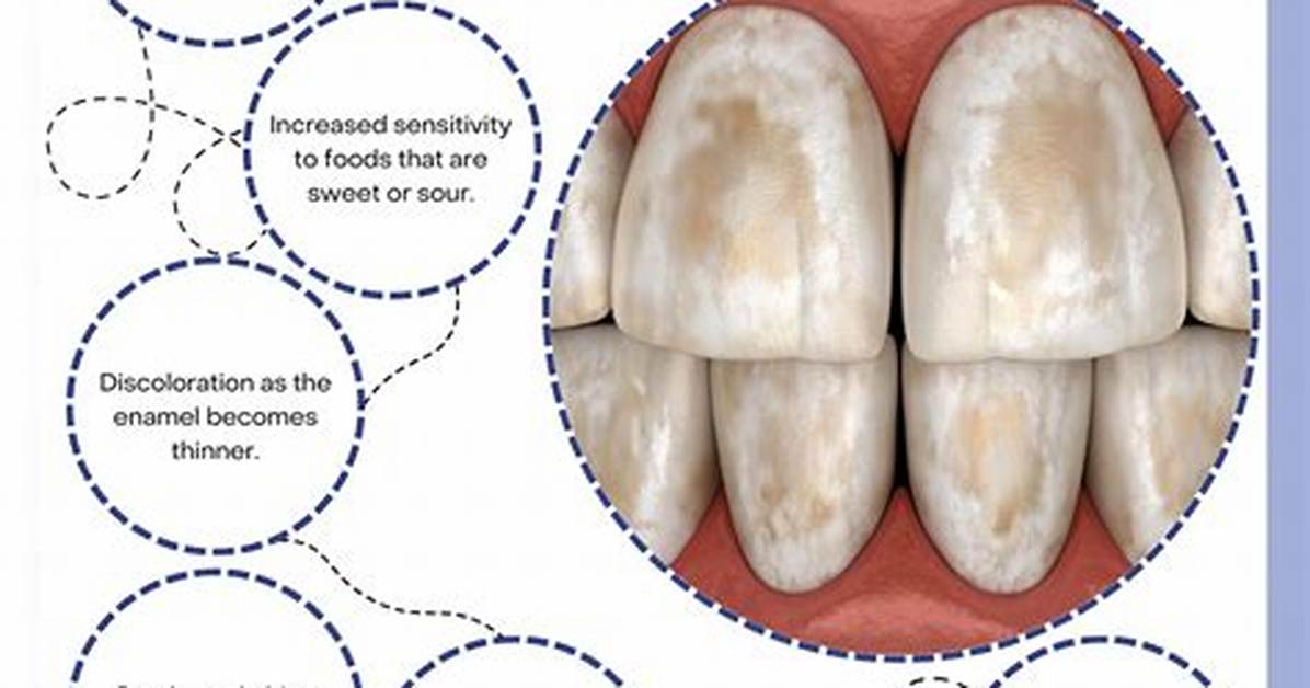 Does Tooth Etching Damage Enamel?