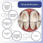 Does Tooth Etching Damage Enamel?