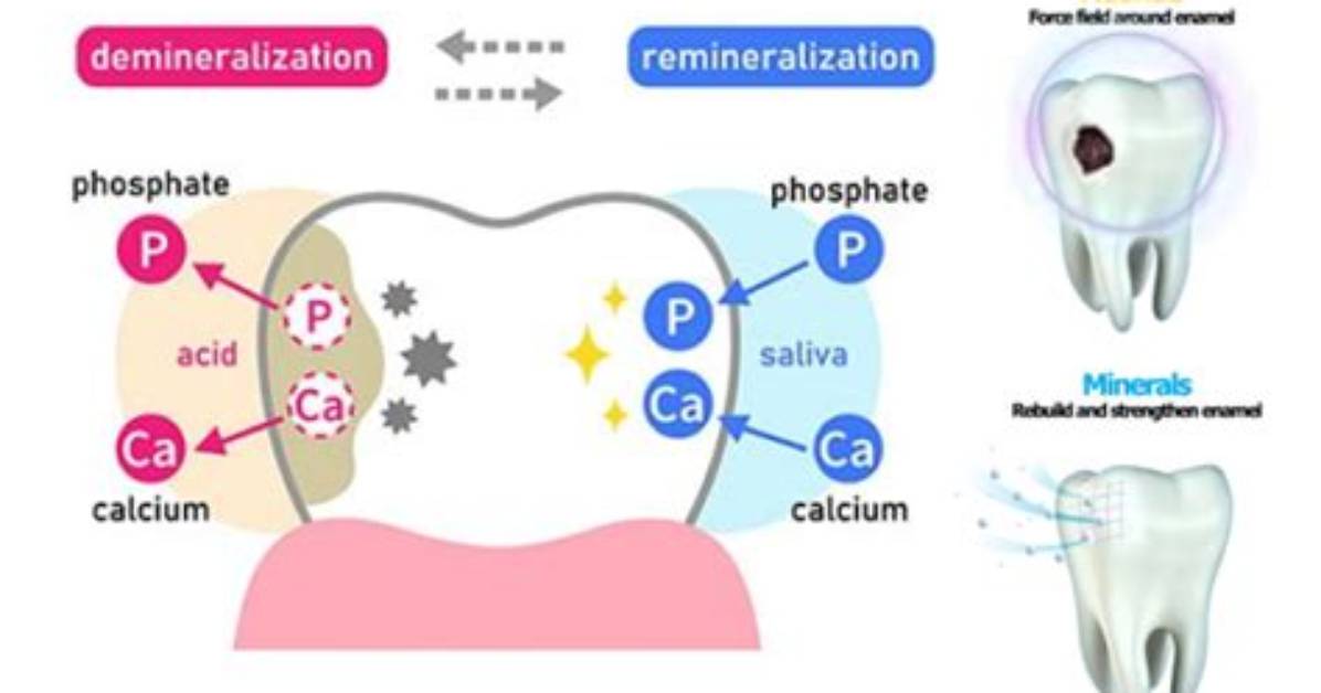 Does Tooth Remineralization Work?