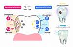 Does Tooth Remineralization Work?