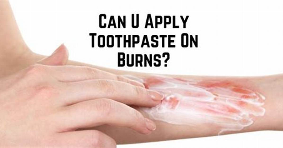 Does Toothpaste Help Burns