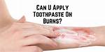Does Toothpaste Help Burns