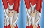 Does Torn Quadriceps Tendon Require Surgery?