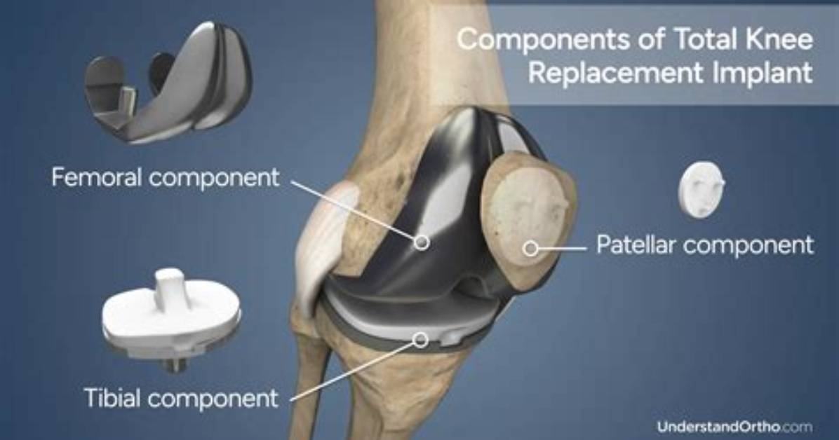 Does Total Knee Replacement Include Kneecap?